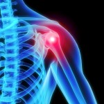 Shoulder Pain - Shoulder Impingement